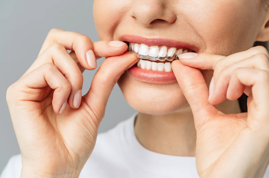aligners-2