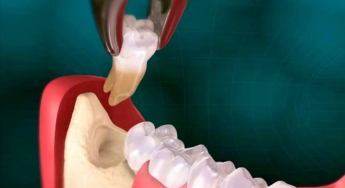 tooth-1