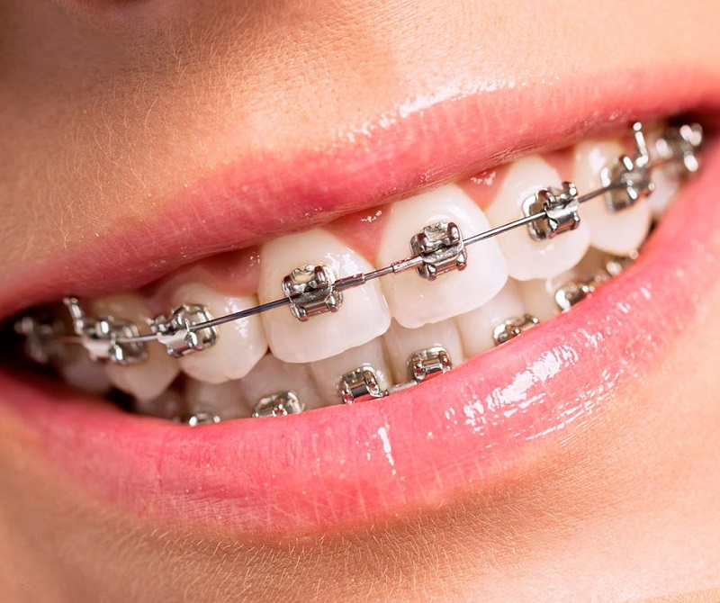 bracket-2
