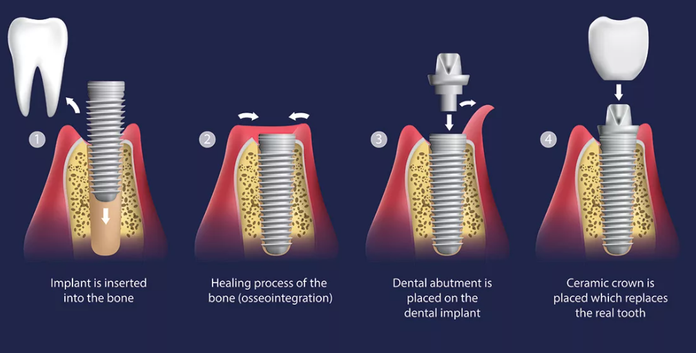 implant
