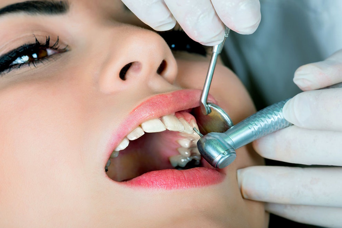 Treatment of caries on the front teeth