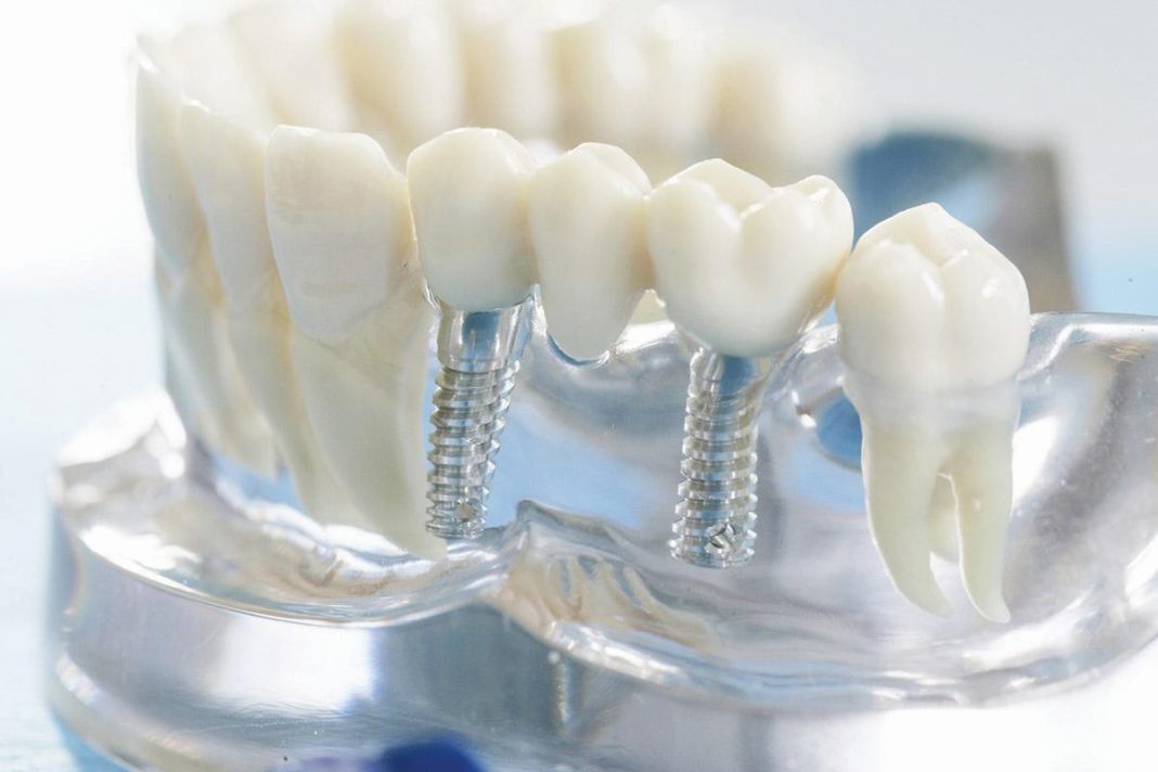 Types of Dental Bridges