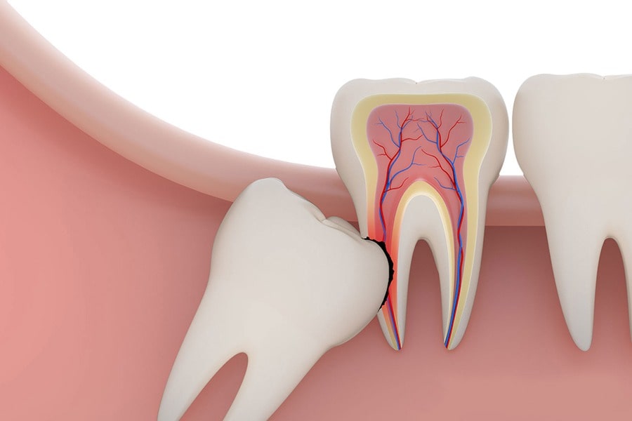 Why doesn't everyone have wisdom teeth?