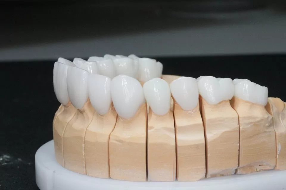 Advantages of metal-free ceramics