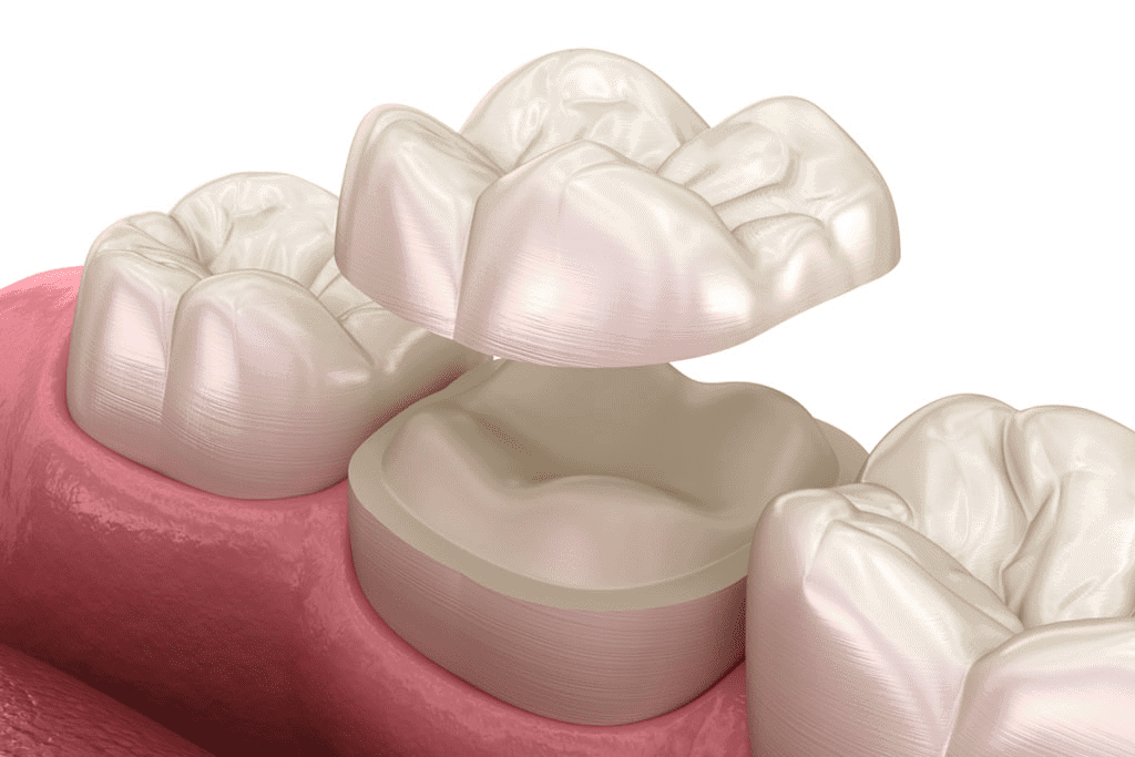 Types of ceramic restorations