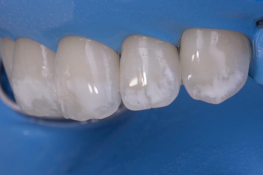 Dental Fluorosis - Treatment with Whitening
