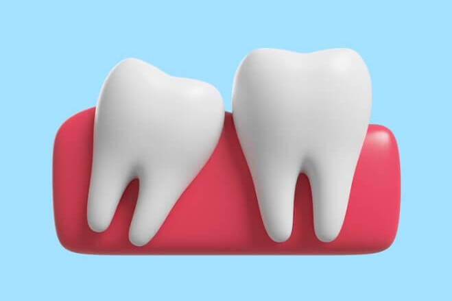 Why do teeth grow crooked?
