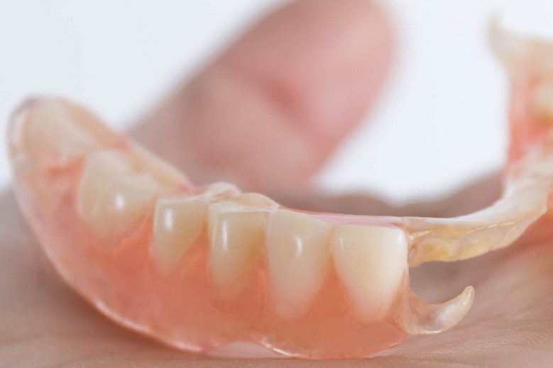 Service life of dental implants