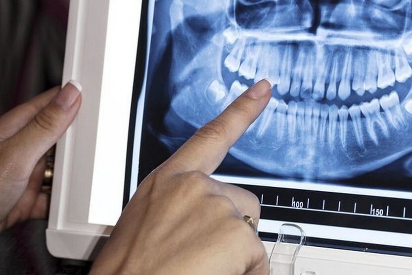 What does a dental orthopantomogram show?