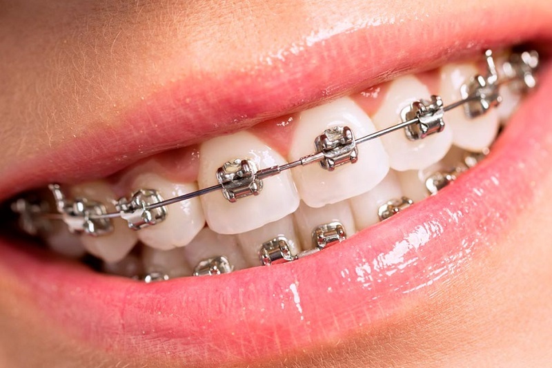 What types of braces are there and how do they differ from each other?