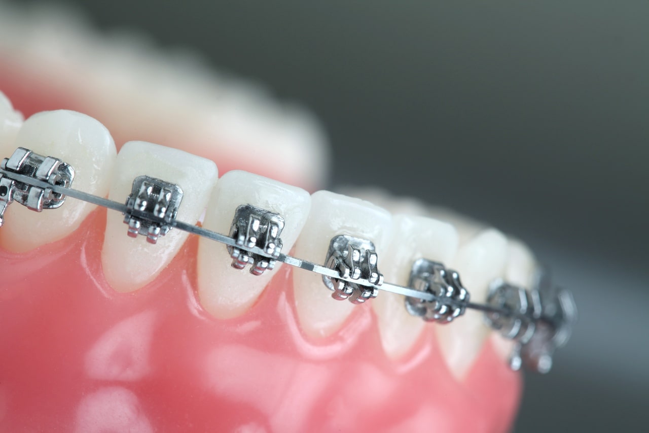 What is orthodontics?