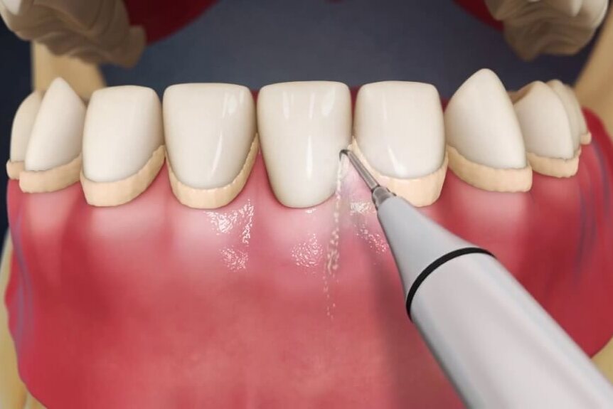 Tartar: Causes, Prevention and Removal