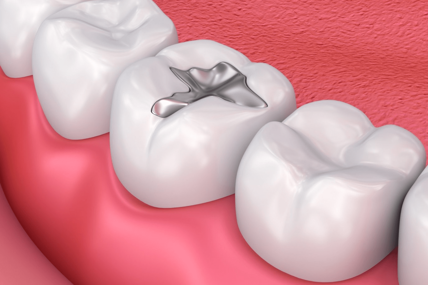 What is dental amalgam?