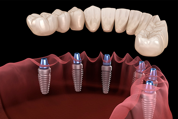 Turnkey implantation