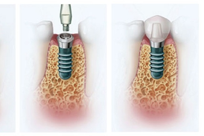 How dental implantation is performed: stages, terms and features of the procedure