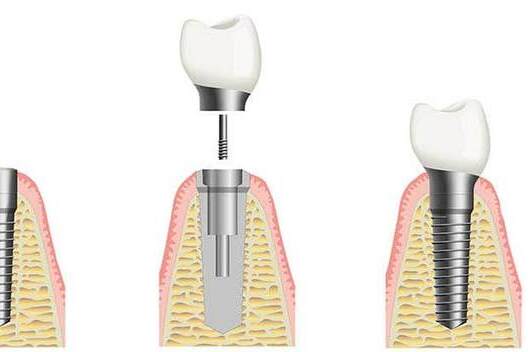 Dental implantation - stages and installation time