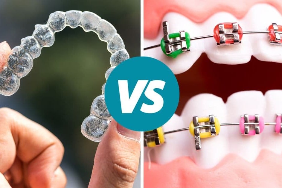 Aligners vs. Braces: The Complete Guide