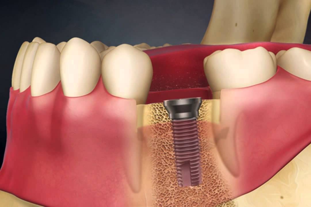 Implantation after tooth extraction