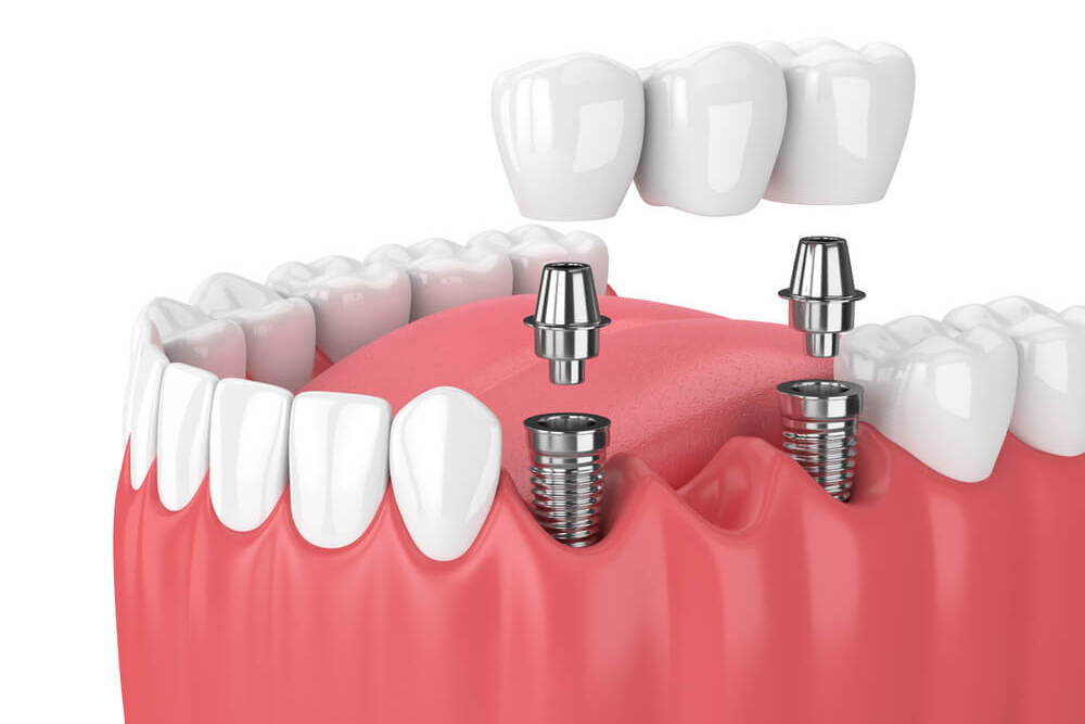 Dental bridges or implants