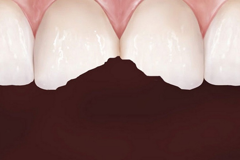 Why do teeth crumble?