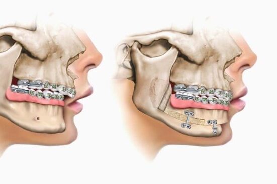 Teeth alignment