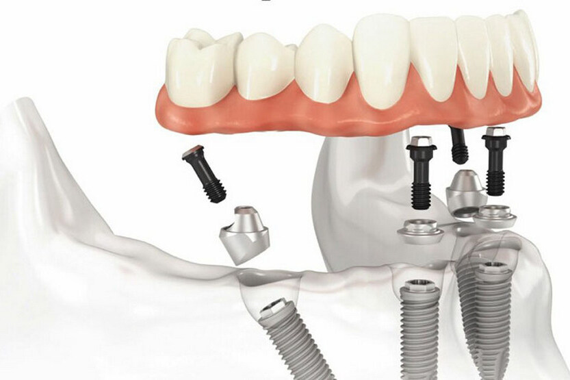 Dental prosthetics: types and prices