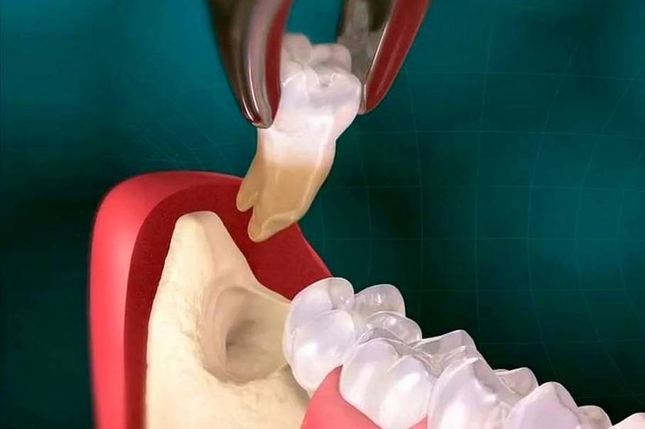 What to do after tooth extraction: recommendations