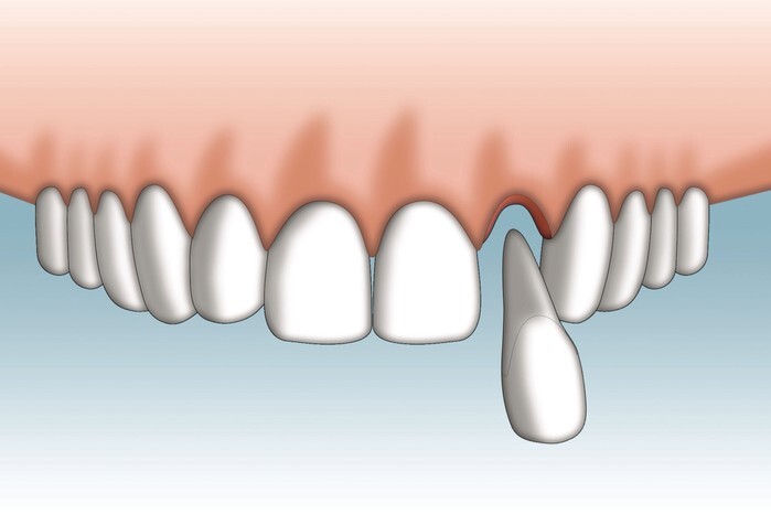 What is important to know after tooth replantation or transplantation?