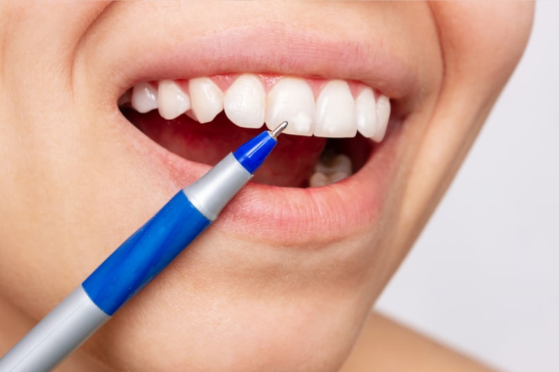 Why do white spots appear on teeth: causes and consequences