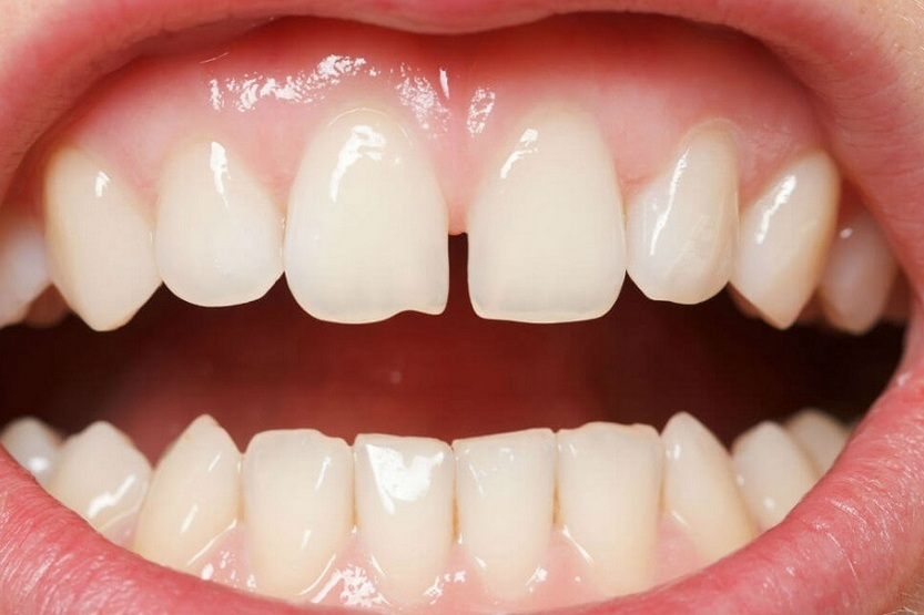 How to close the gap between the front teeth