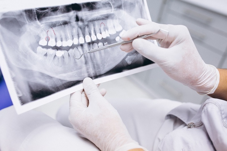 Teeth alignment with aligners: who is it suitable for and what is special about the procedure?