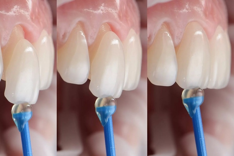 How are veneers installed on teeth