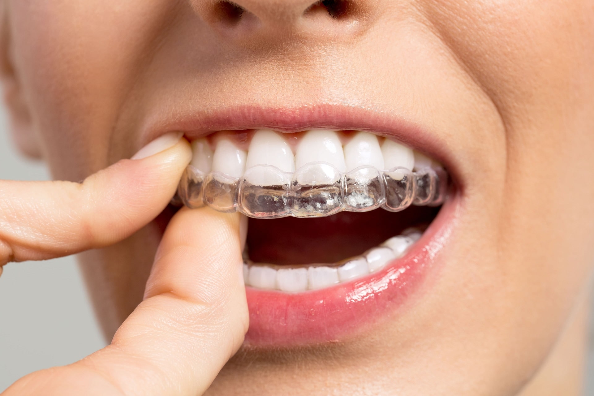 Is it possible to install braces or aligners on teeth without nerves?