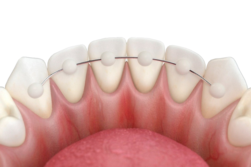 Will the correct bite be preserved after removing the braces for a long time?
