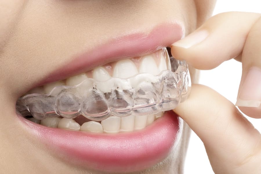 Invisible Aligners: Modern Teeth Straightening Solution