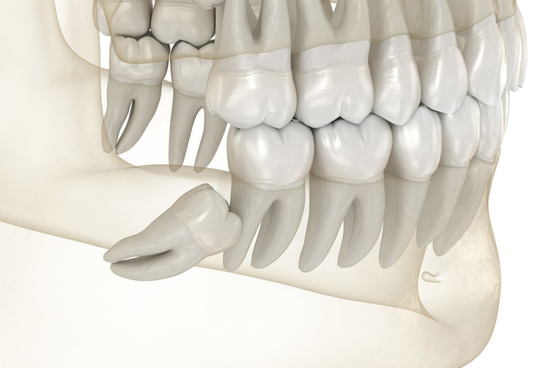 Does every person have a wisdom tooth?