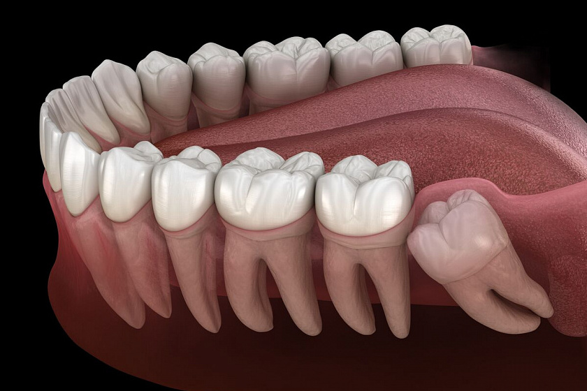 Wisdom Teeth: Should They Be Removed or Treated?